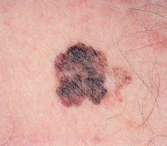 Melanoma: scoperto come viene 'raggirato' il sistema immunitario Melanoma: scoperto come viene 'raggirato' il sistema immunitario